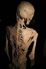 Skeleton of Harry Raymond Eastlack, fibrodysplasia ossificans progressiva sufferer