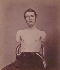 Portrait of Alfred A. Stratton, American Civil War amputee who lost both arms at age 19