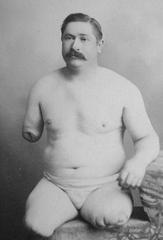 Portrait of J. McKnight, a 32-year-old man who lost all limbs in a 1865 railway accident
