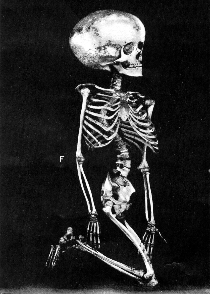 Skeleton with hydrocephalus showing enlarged skull