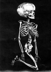 Skeleton with hydrocephalus showing enlarged skull